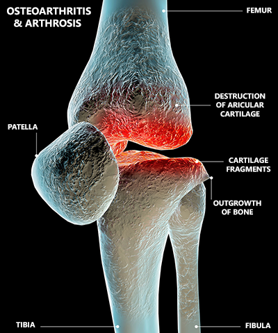 Osteoarthritis root cause can be helped by taking deer velvet and astaxanthin health supplements